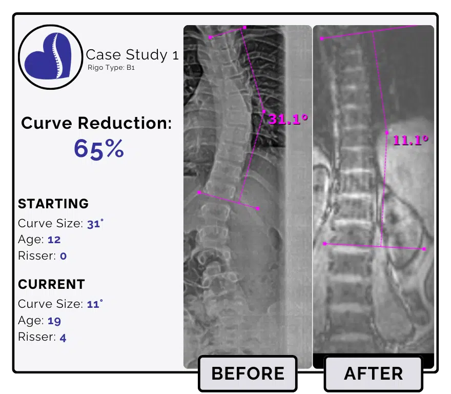 Before and after scoliosis treatment showing 31-degree curve reduction with detailed starting and current info, including percentage of curve reduction and comparison images.