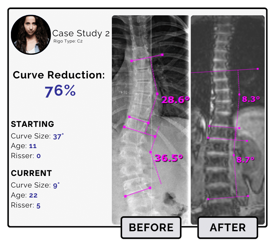 Before and after scoliosis treatment showing 37-degree curve reduction with detailed starting and current info, including percentage of curve reduction and comparison images.