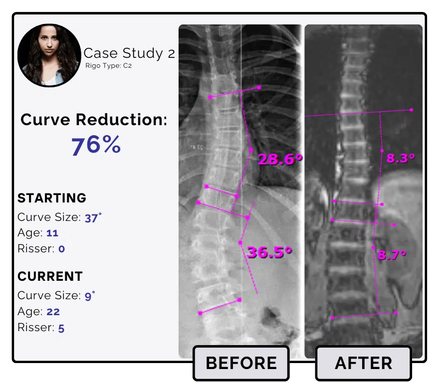 Before and after scoliosis treatment showing 37-degree curve reduction with detailed starting and current info, including percentage of curve reduction and comparison images.