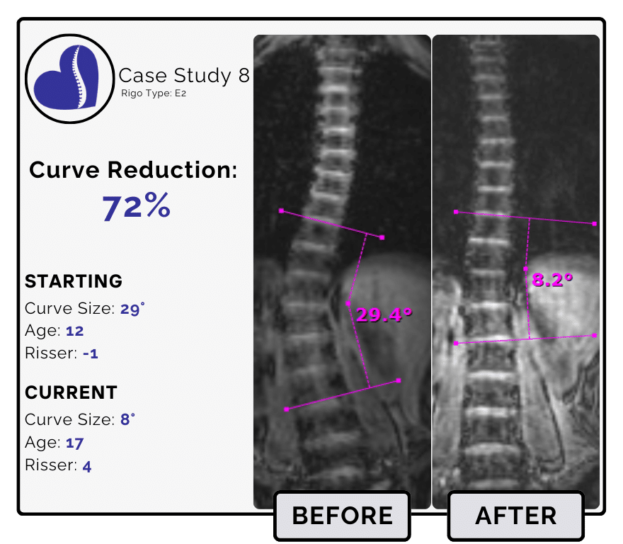 Before and after scoliosis treatment showing 29-degree curve reduction with detailed starting and current info, including percentage of curve reduction and comparison images.
