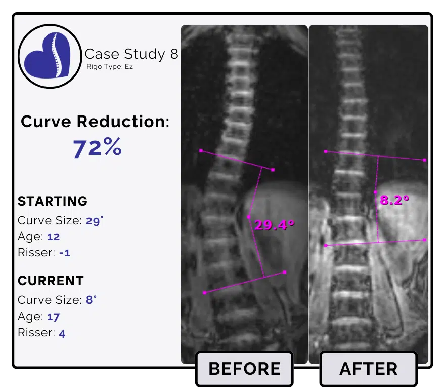 Before and after scoliosis treatment showing 29-degree curve reduction with detailed starting and current info, including percentage of curve reduction and comparison images.