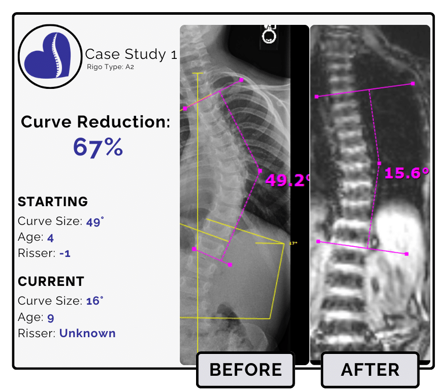 Before and after scoliosis treatment showing 49-degree curve reduction with detailed starting and current info, including percentage of curve reduction and comparison images.