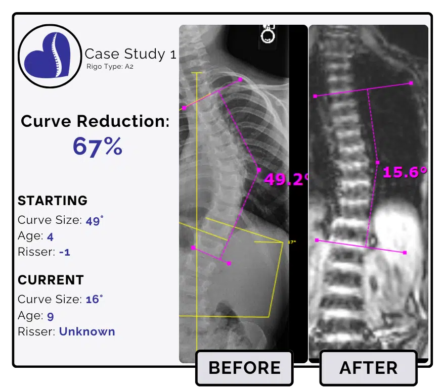 Before and after scoliosis treatment showing 49-degree curve reduction with detailed starting and current info, including percentage of curve reduction and comparison images.