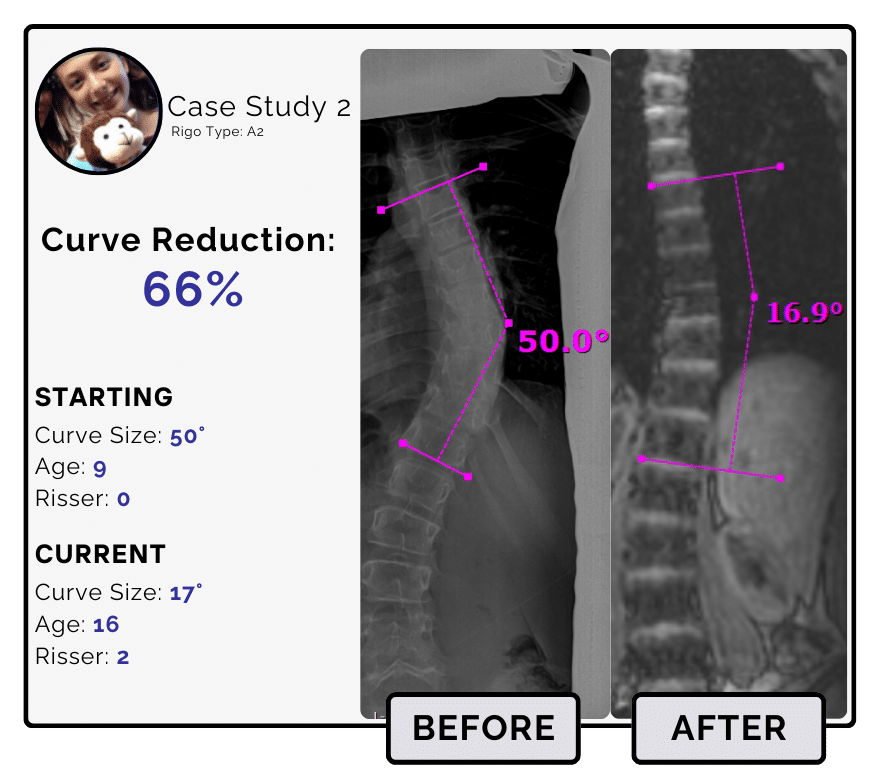 Before and after scoliosis treatment showing 50-degree curve reduction with detailed starting and current info, including percentage of curve reduction and comparison images.