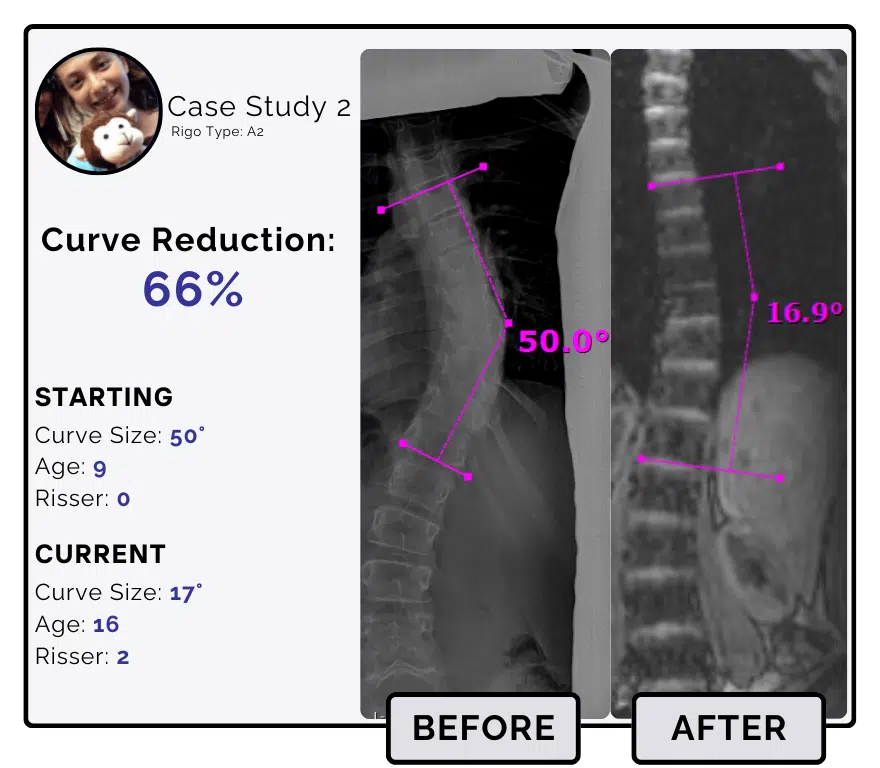 Before and after scoliosis treatment showing 50-degree curve reduction with detailed starting and current info, including percentage of curve reduction and comparison images.