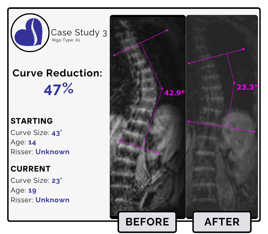 Before and after scoliosis treatment showing 43-degree curve reduction with detailed starting and current info, including percentage of curve reduction and comparison images.