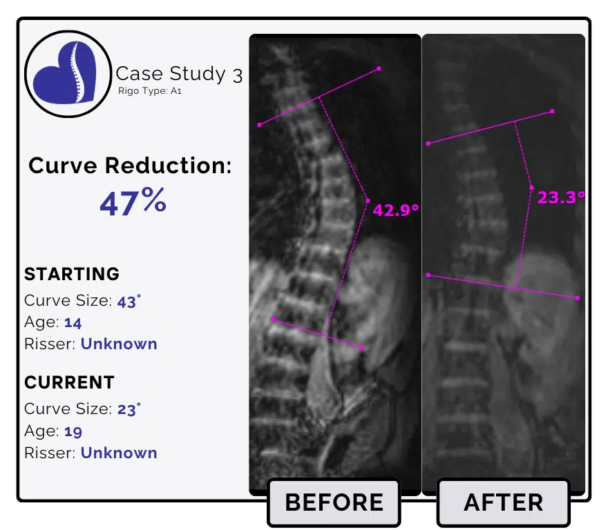 Before and after scoliosis treatment showing 43-degree curve reduction with detailed starting and current info, including percentage of curve reduction and comparison images.