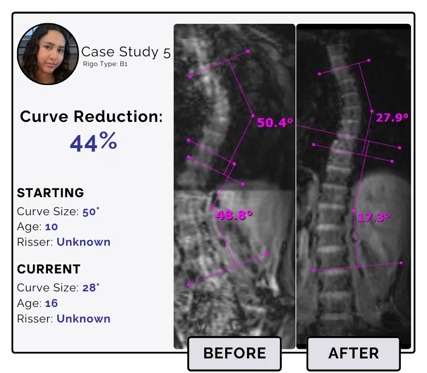 Before and after scoliosis treatment showing 50-degree curve reduction with detailed starting and current info, including percentage of curve reduction and comparison images.