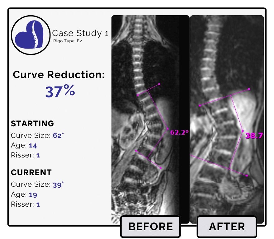 Before and after scoliosis treatment showing 62-degree curve reduction with detailed starting and current info, including percentage of curve reduction and comparison images.