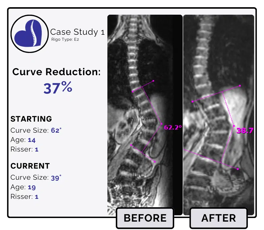 Before and after scoliosis treatment showing 62-degree curve reduction with detailed starting and current info, including percentage of curve reduction and comparison images.