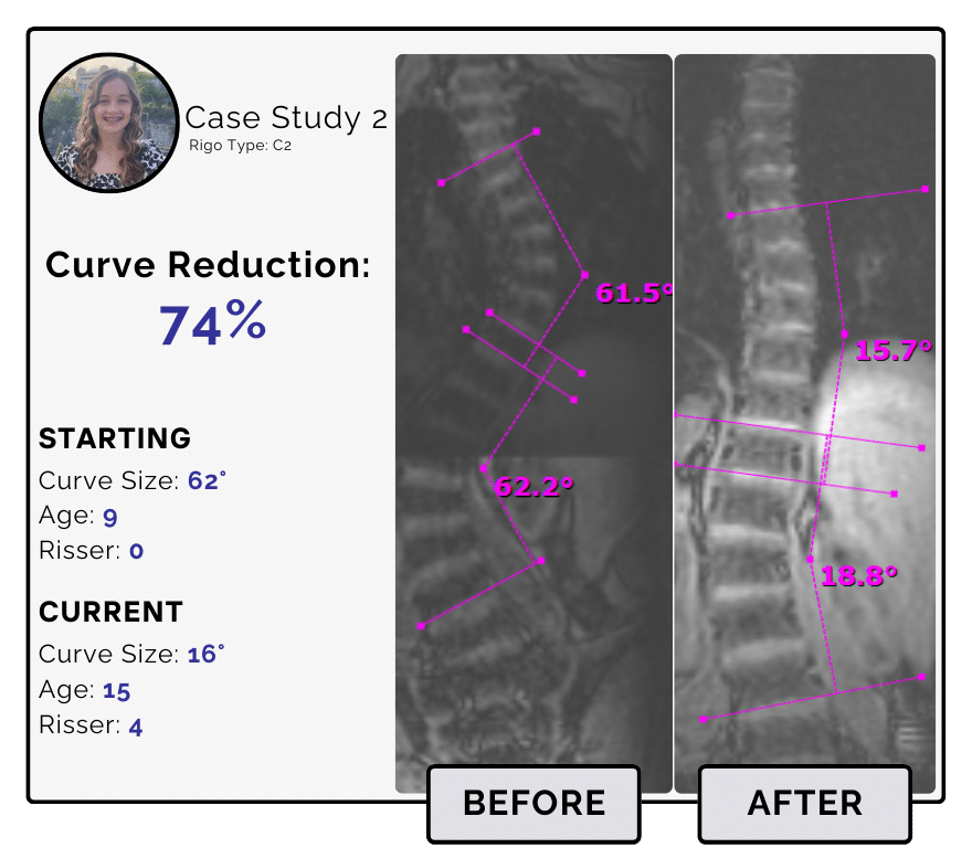 Before and after scoliosis treatment showing 62-degree curve reduction with detailed starting and current info, including percentage of curve reduction and comparison images.