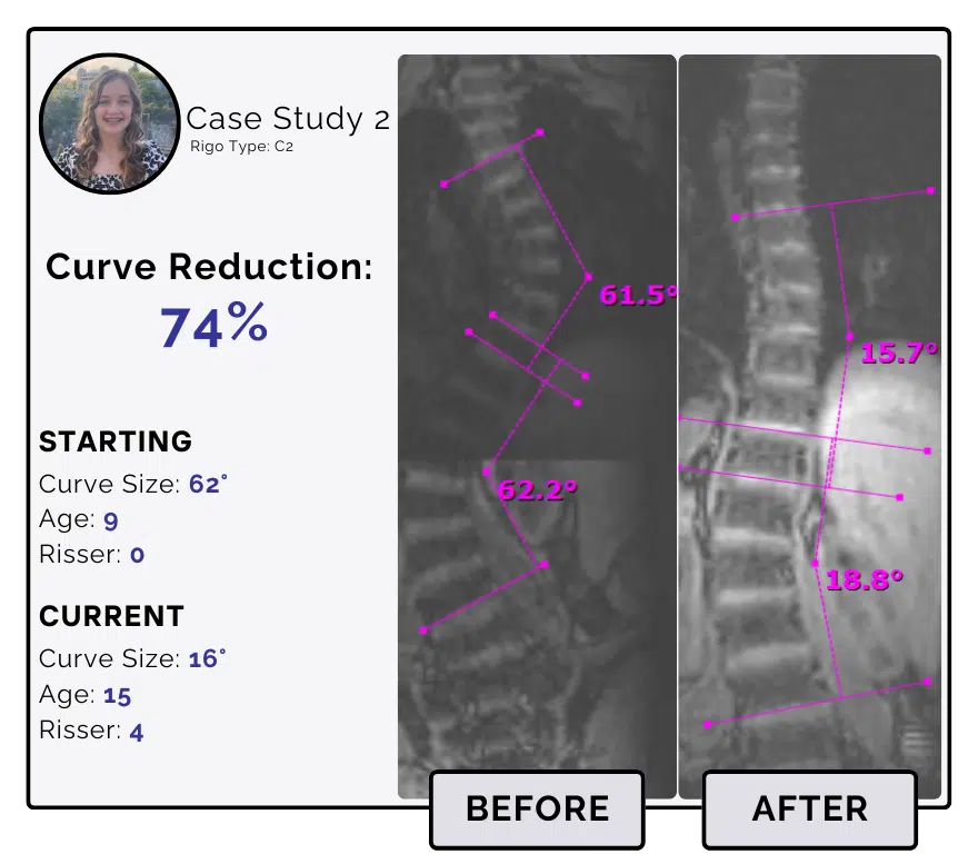 Before and after scoliosis treatment showing 62-degree curve reduction with detailed starting and current info, including percentage of curve reduction and comparison images.