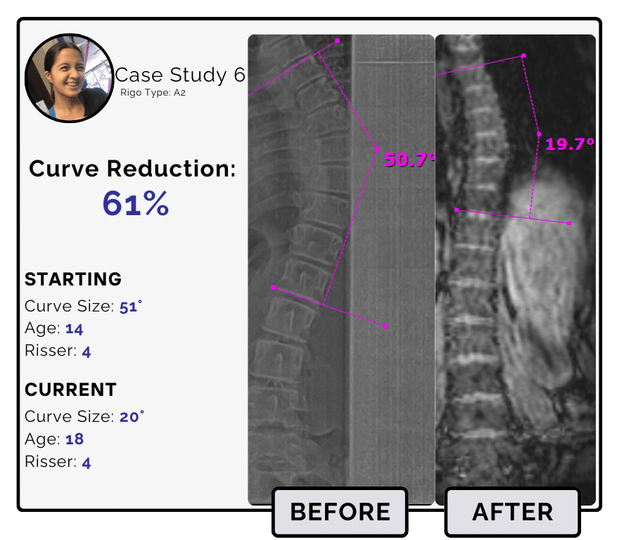 Before and after scoliosis treatment showing 51-degree curve reduction with detailed starting and current info, including percentage of curve reduction and comparison images.
