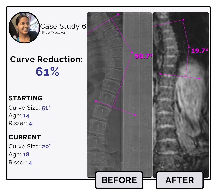 Before and after scoliosis treatment showing 51-degree curve reduction with detailed starting and current info, including percentage of curve reduction and comparison images.