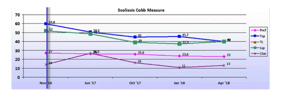 Graph showing scoliosis curve progression from start to end, detailing degrees of curve reduction.