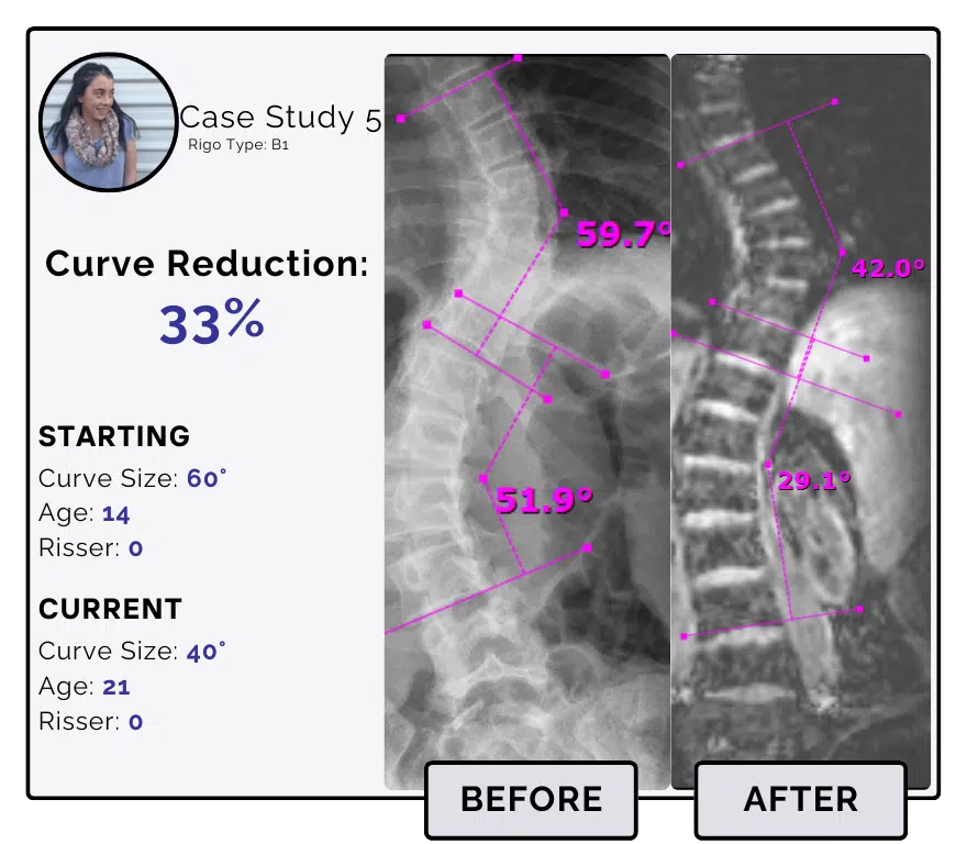 Before and after scoliosis treatment showing 60-degree curve reduction with detailed starting and current info, including percentage of curve reduction and comparison images.