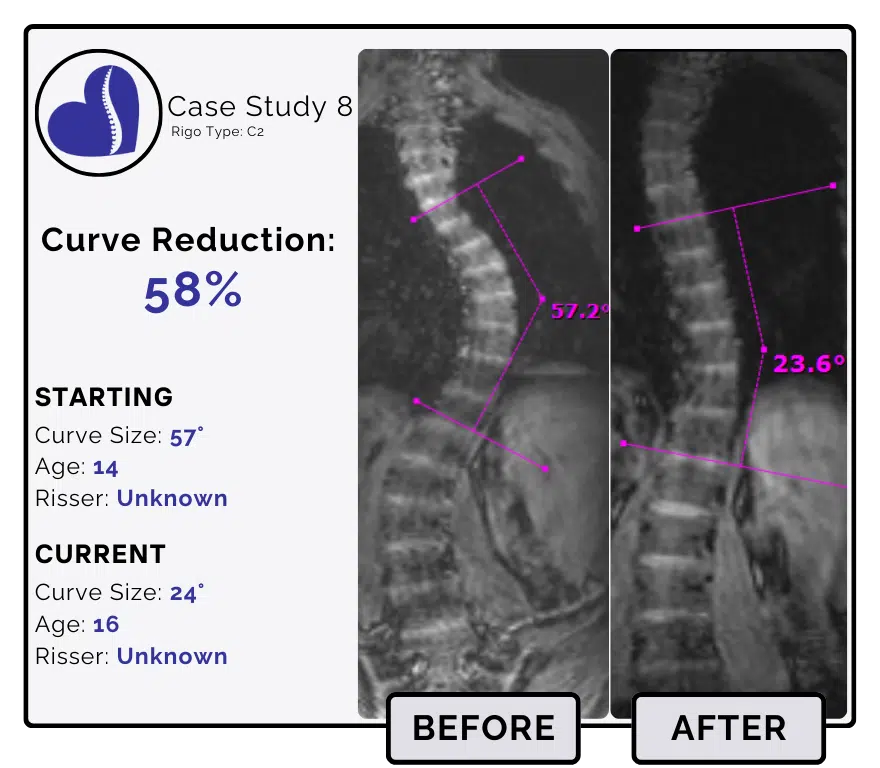 Before and after scoliosis treatment showing 57-degree curve reduction with detailed starting and current info, including percentage of curve reduction and comparison images.