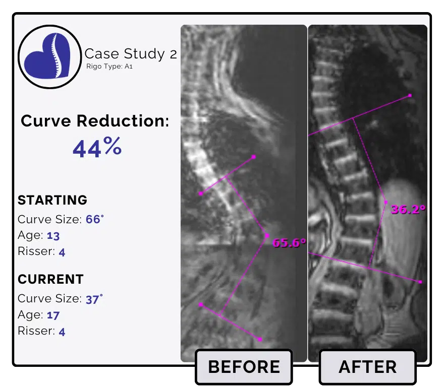 Before and after scoliosis treatment showing 66-degree curve reduction with detailed starting and current info, including percentage of curve reduction and comparison images.