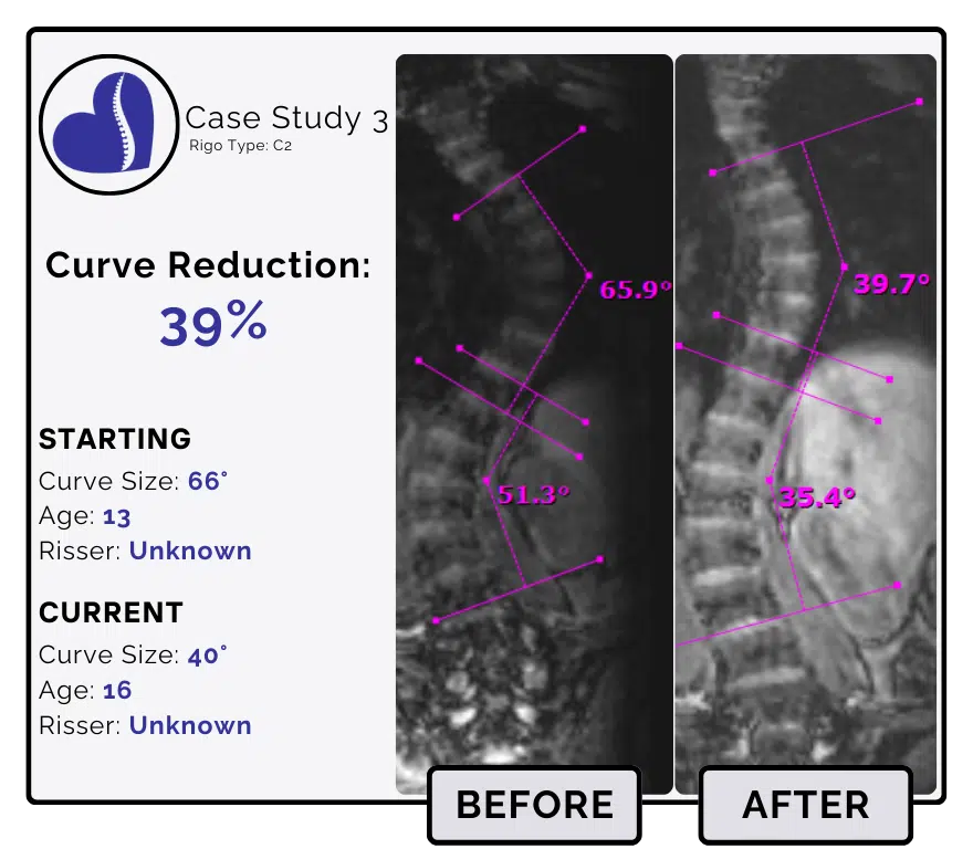 Before and after scoliosis treatment showing 66-degree curve reduction with detailed starting and current info, including percentage of curve reduction and comparison images.