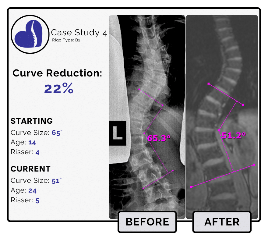 Before and after scoliosis treatment showing 65-degree curve reduction with detailed starting and current info, including percentage of curve reduction and comparison images.