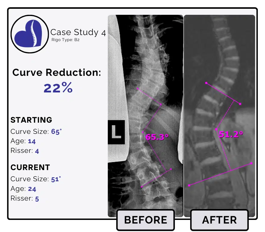 Before and after scoliosis treatment showing 65-degree curve reduction with detailed starting and current info, including percentage of curve reduction and comparison images.