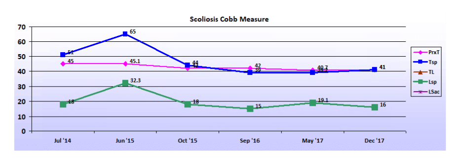 Graph showing scoliosis curve progression from start to end, detailing degrees of curve reduction.