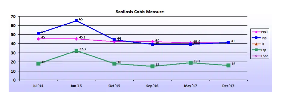 Graph showing scoliosis curve progression from start to end, detailing degrees of curve reduction.