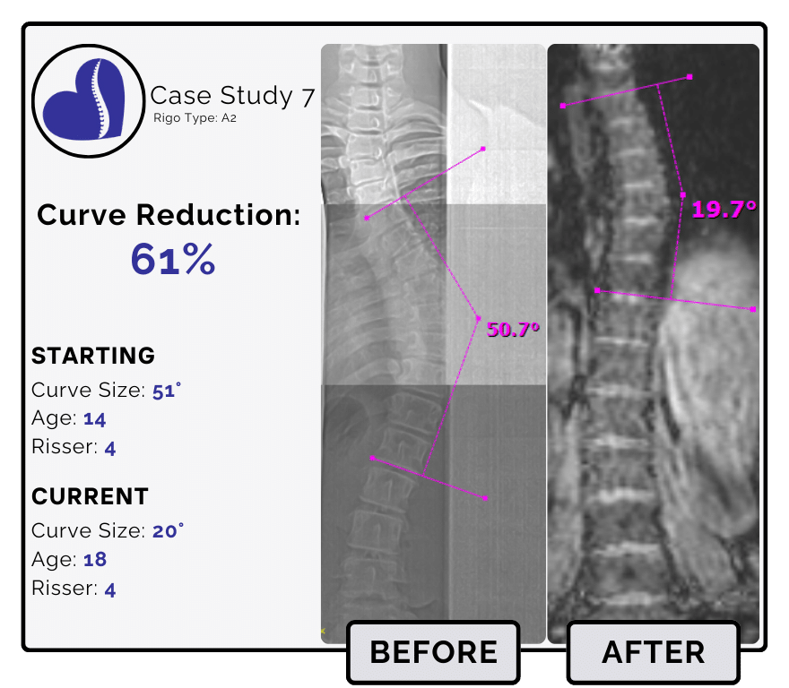 Before and after scoliosis treatment showing 51-degree curve reduction with detailed starting and current info, including percentage of curve reduction and comparison images.