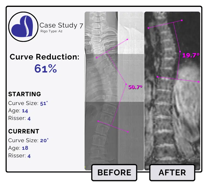 Before and after scoliosis treatment showing 51-degree curve reduction with detailed starting and current info, including percentage of curve reduction and comparison images.