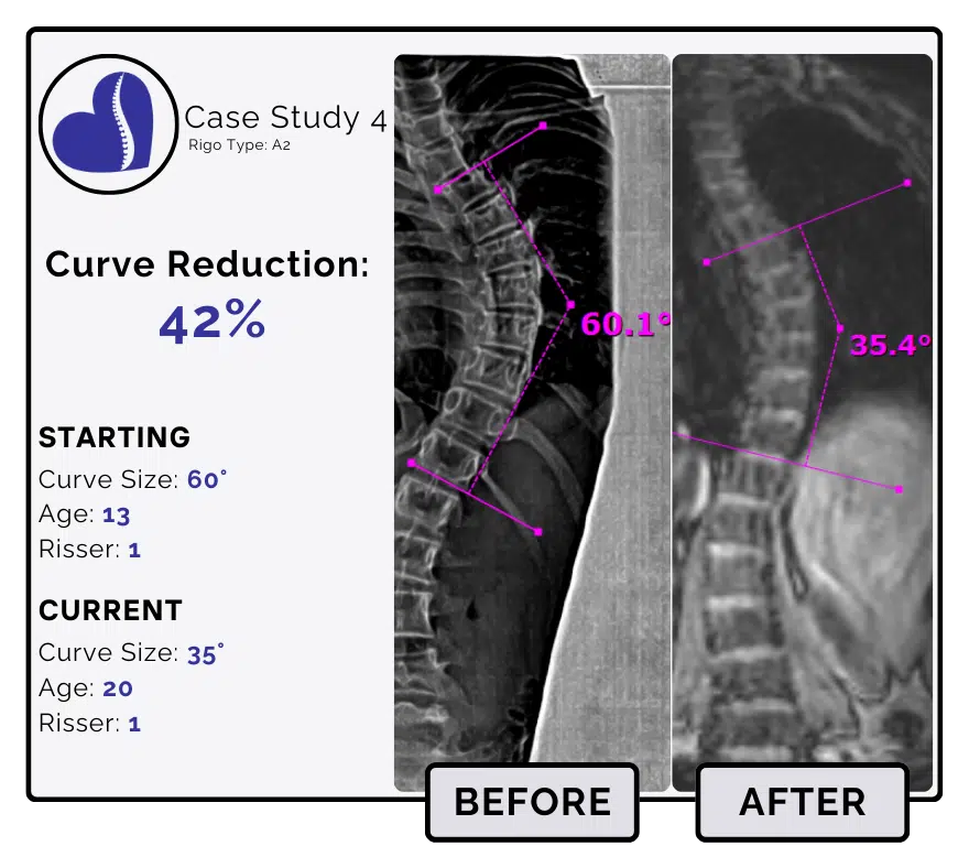 Before and after scoliosis treatment showing 60-degree curve reduction with detailed starting and current info, including percentage of curve reduction and comparison images.