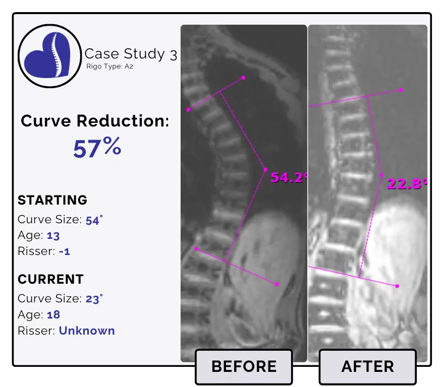 32-Degree Scoliosis Curve Reduction: Before and After Treatment