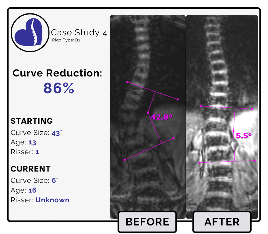 Before and after scoliosis treatment showing 43-degree curve reduction with detailed starting and current info, including percentage of curve reduction and comparison images.