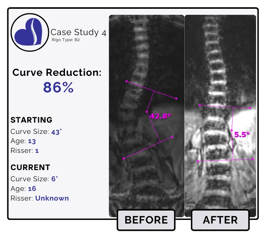 Before and after scoliosis treatment showing 43-degree curve reduction with detailed starting and current info, including percentage of curve reduction and comparison images.