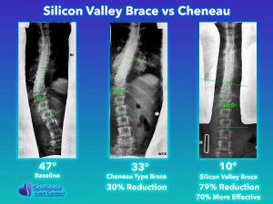Cheneau Type Brace Comparison to Silicon Valley Brace #2