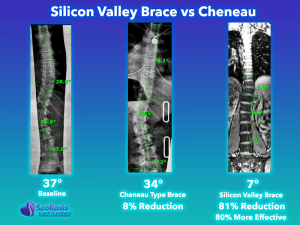 Cheneau Type Brace Comparison to Silicon Valley Brace #3