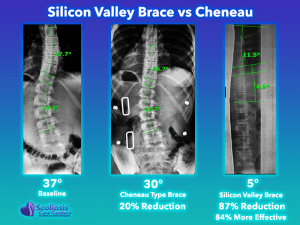 Cheneau Type Brace Comparison to Silicon Valley Brace