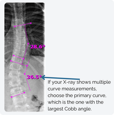 Cobb Angle Example