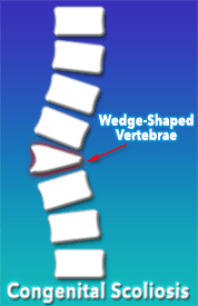 Congenital Scoliosis - Wedge shaped vertebrae