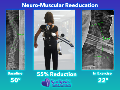 Scoliosis Exercises To Improve Posture Strength Scoliosis Care Centers