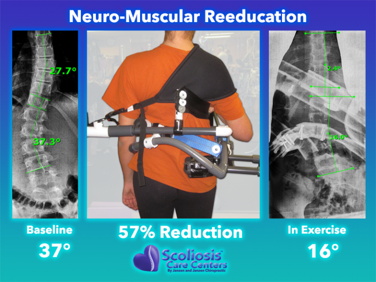 Scoliosis Exercises To Improve Posture & Strength - Scoliosis Care Centers