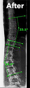 Failure treating scoliosis with chiropractic manipulation - After