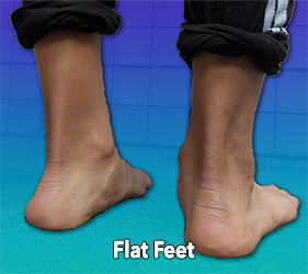 Early Signs of Scoliosis - Flat Feet