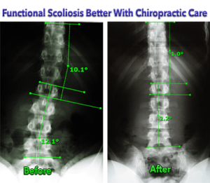 Functional Scoliosis Better with Chiropractic Care Before and After Xrays