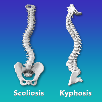 Kyphosis - Scoliosis Care Centers