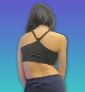 Postural Analysis for scoliosis detection