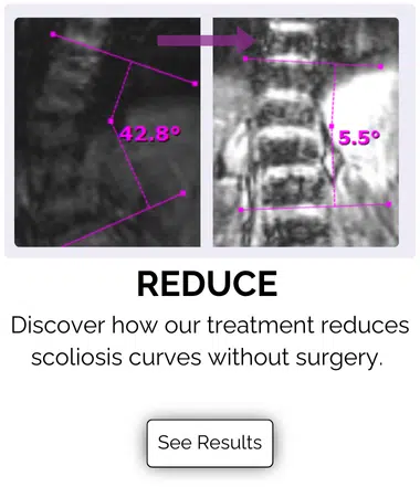 Scoliosis Treatment Results for nonsurgical treatment