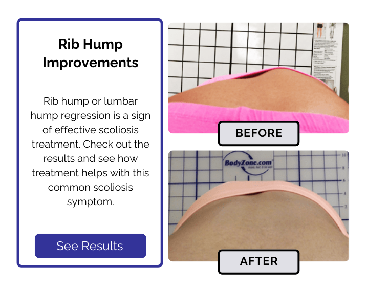 Scoliosis treatment results by Rib Hump Improvements.