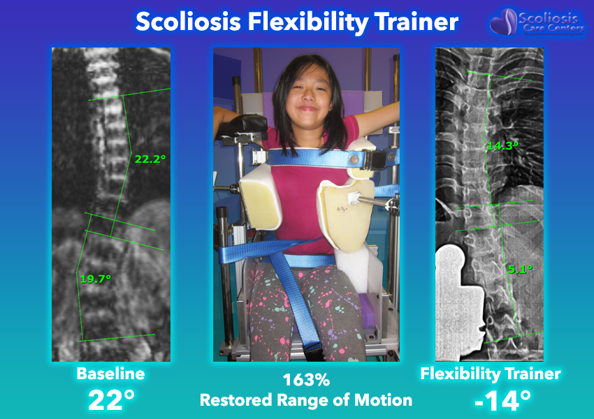Fixing scoliosis with the scoliosis flexibility trainer