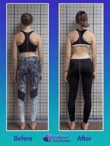 Scoliosis Treatment Results Posture Transformation