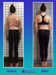Uneven back from scoliosis treatment exercises